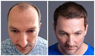 Bosley patient Chuck before and after