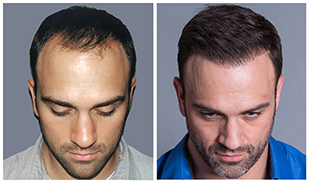 Bosley patient Jeff before and after