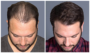 Bosley patient Matthew Z. before and after