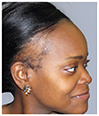 Bosley patient Kelly before