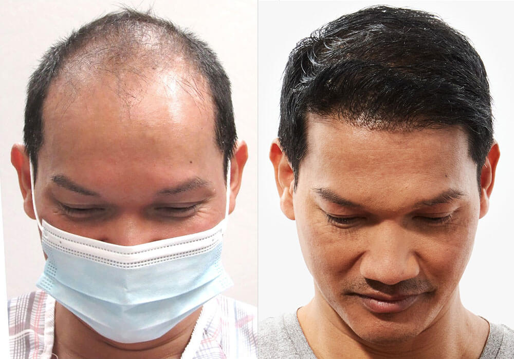Dee before after