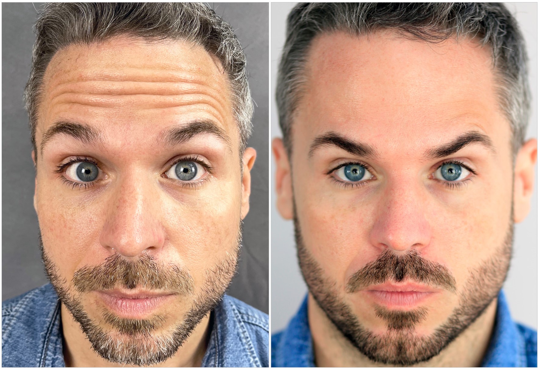 Aaron F. Actual Bosley Botox Patient Before and After Image