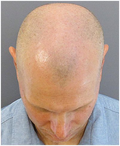 Bosley SMP Patient - Brett Stoll - Before Small