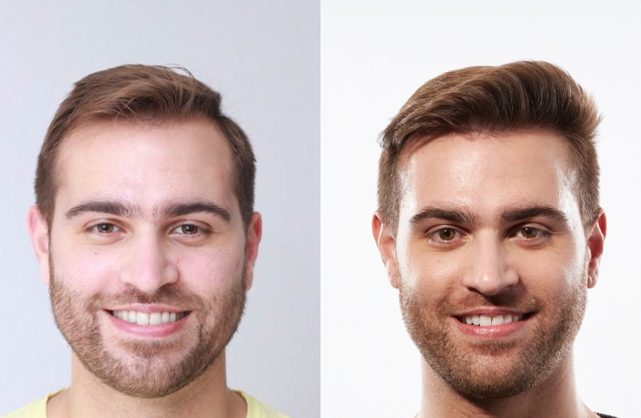 Bosley Patient - Brandon B. - FUE PRP