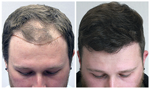 Bosley Patient Ryan B - Before and After