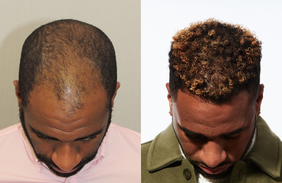 Bosley Patient - Ryan N. - FUE
