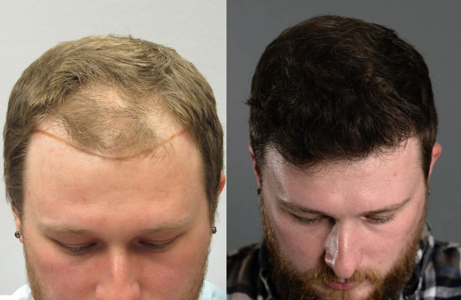 Bosley Patient - Ryan S. - FUE