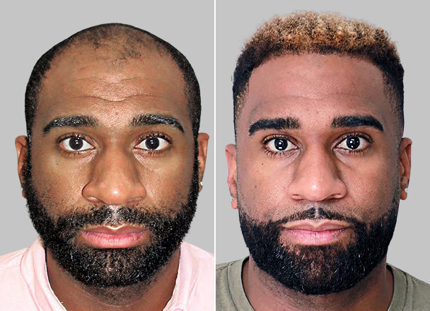 before-after-2