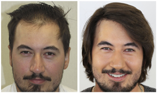 Bosley patient Devin before and after