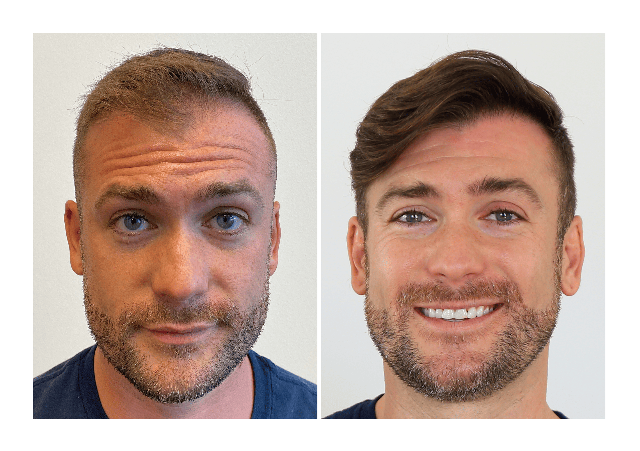 Bosley patient Brandon Rolko - Before and after pictures