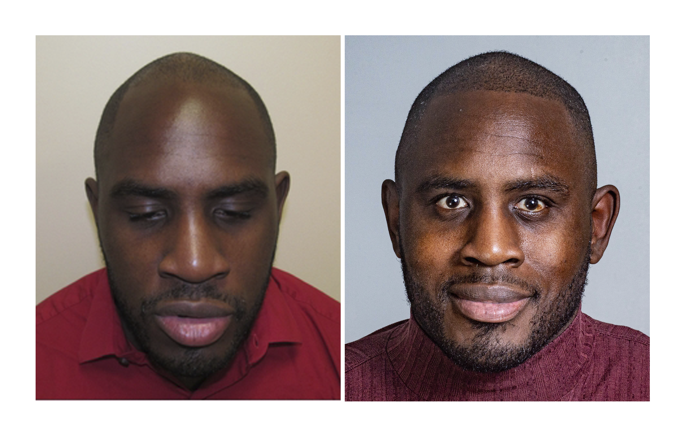 Bosley patient Edward Latimore - Before and after pictures