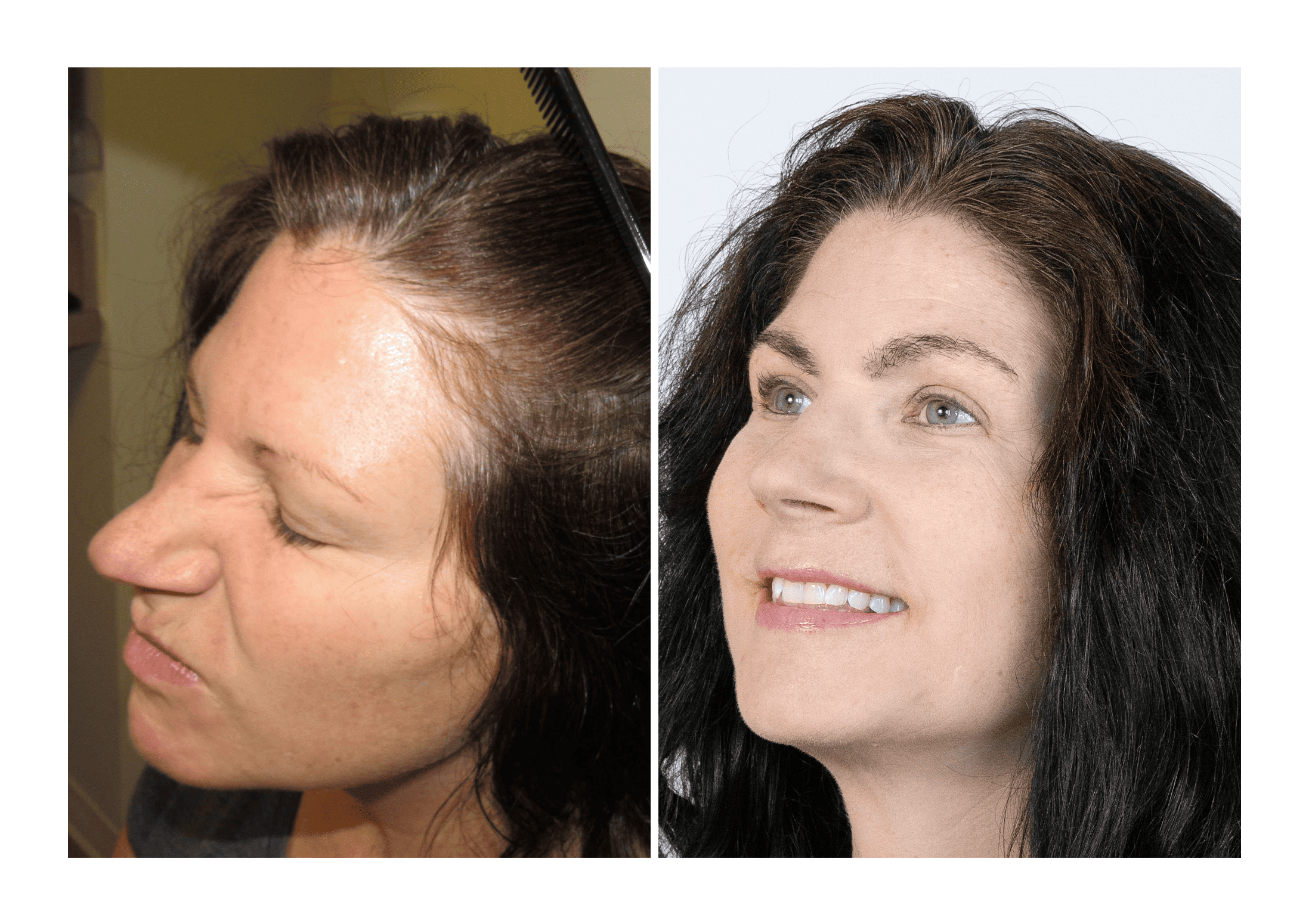 Bosley patient Dr. Heather Cook before and after pictures - Right