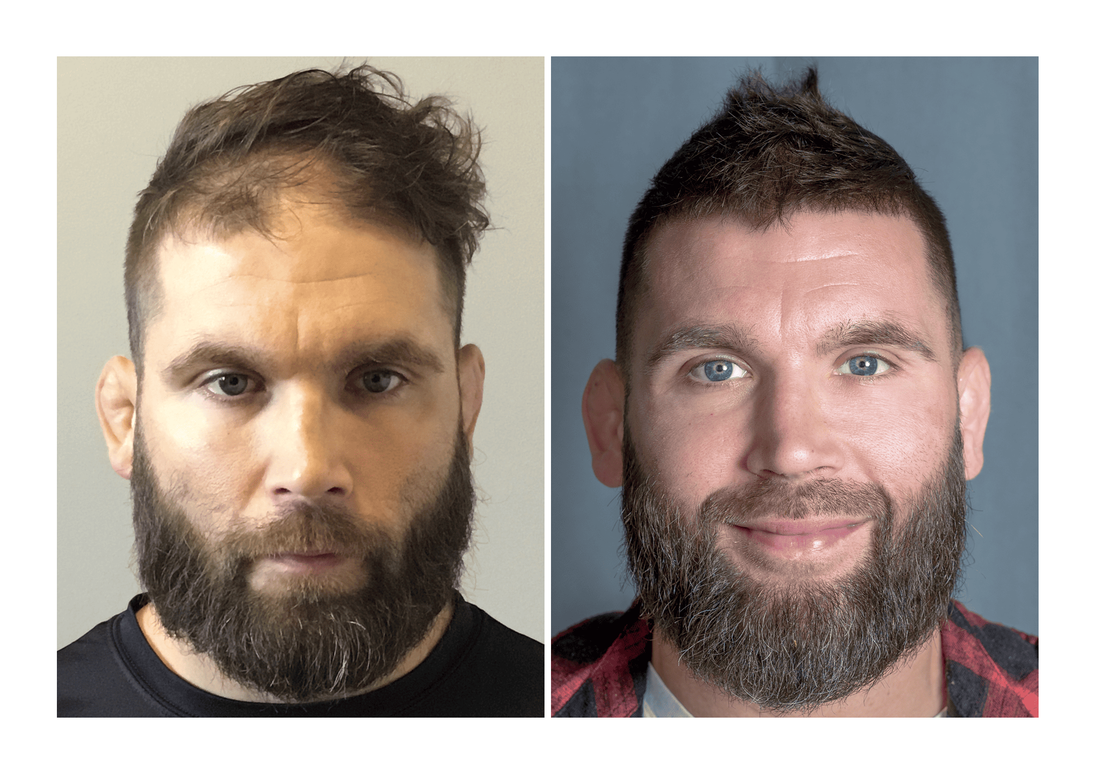 Bosley patient Jeremy S. - Before and after pictures