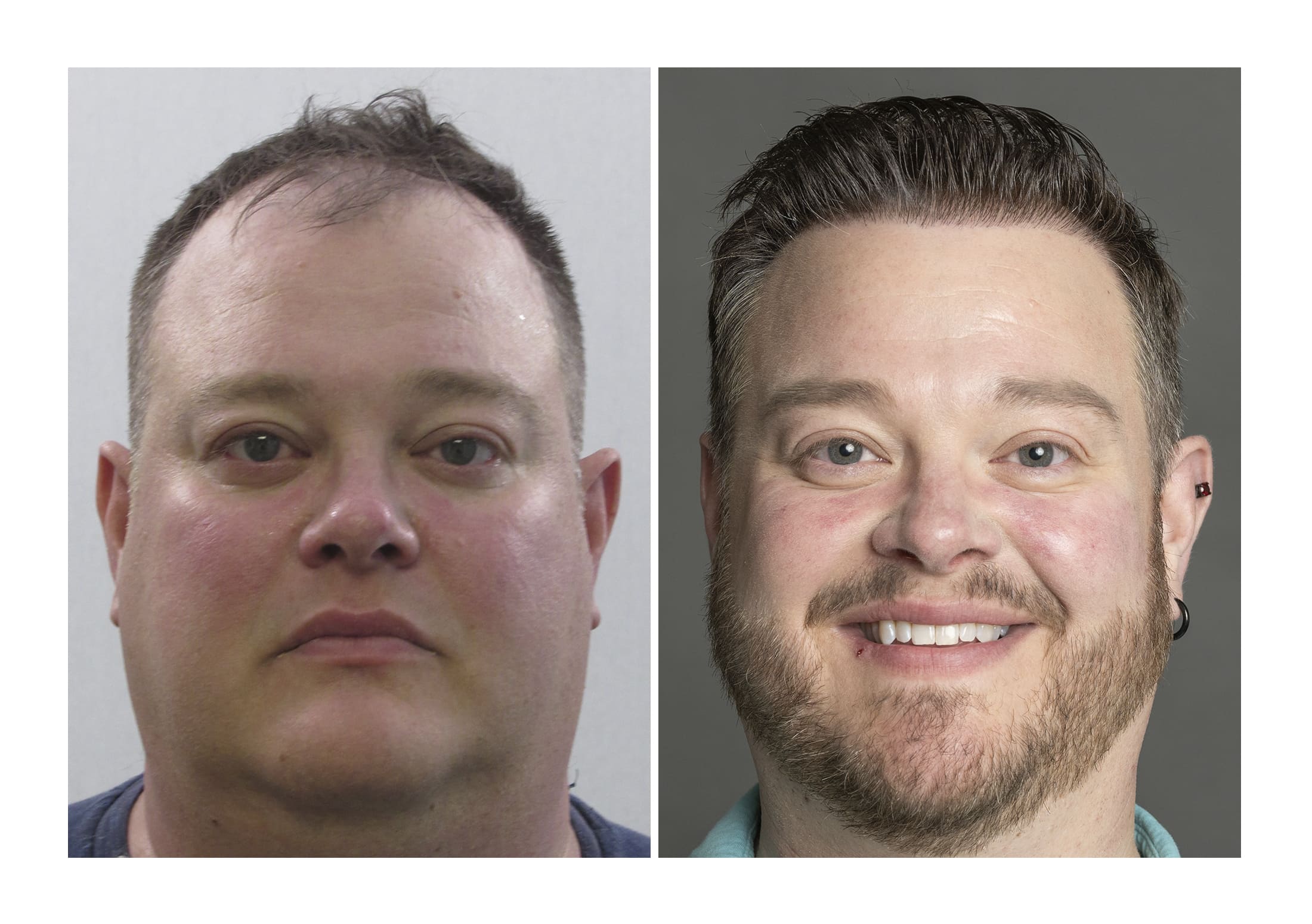 Bosley patient Matthew Zipko - Before and after pictures