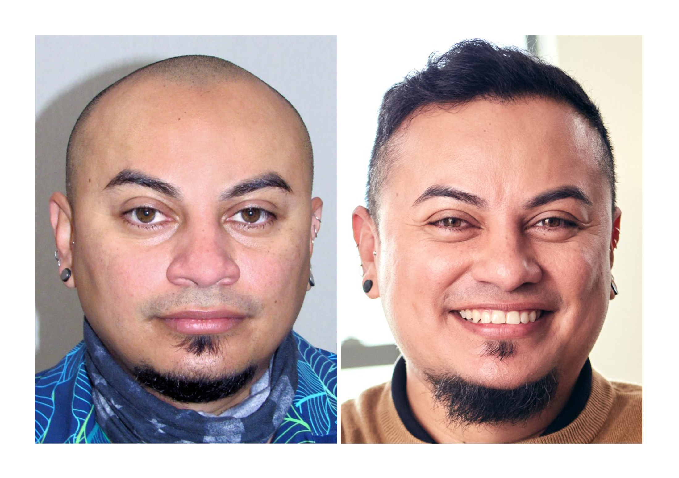 Bosley patient Oscar C. before and after pictures