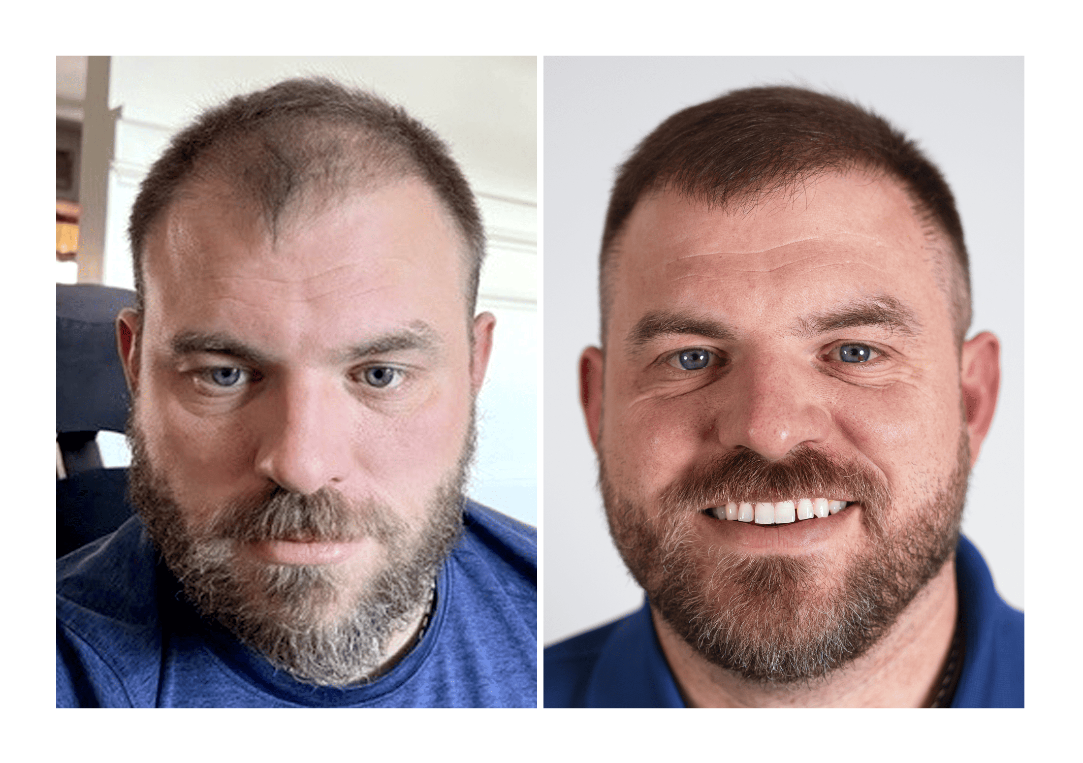 Bosley patient Travis - Before and after pictures