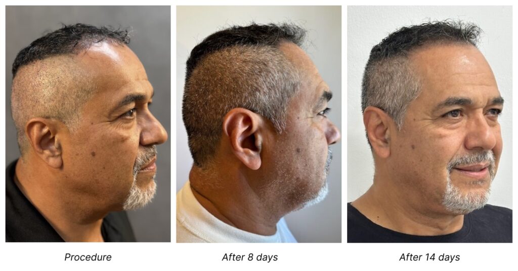 rich shave free fue