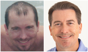 Bosley Patient Patrick S. B&A