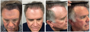 Bosley Patient B&A corrective surgery