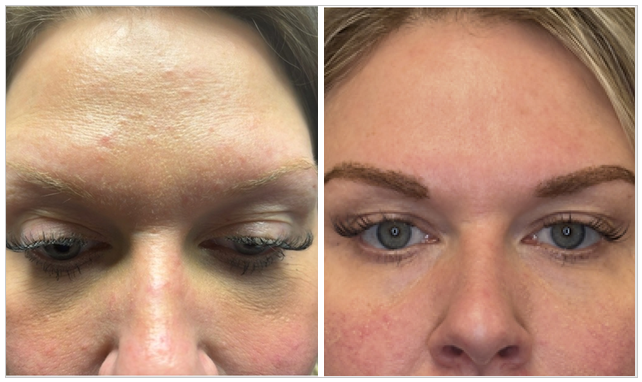 sarah J. Bosley before and after patient. eyebrows